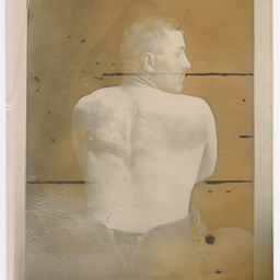 Man with back injuries